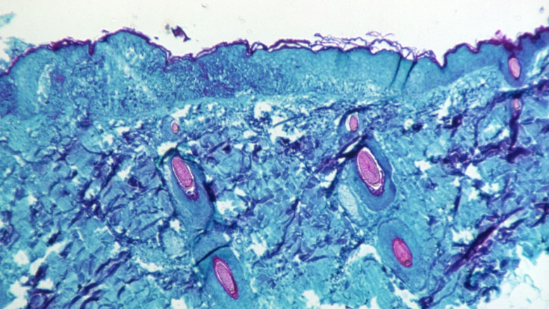 What exactly is monkeypox, and how is it spreading?